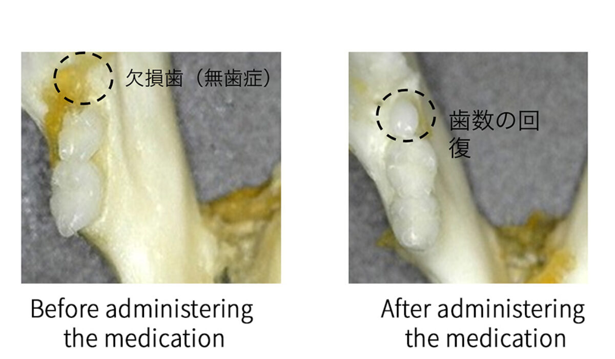 human teeth restoration